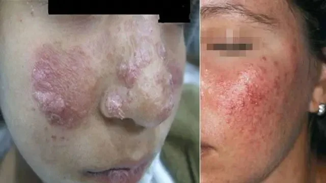 imgi_5_Protect-your-Skin-from-insect-Diseases-Elite-Pest-Control-144559645