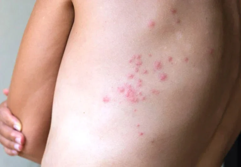 imgi_8_65d2823e0a4cee956aa298d4_90dda05e-e6f4-4667-a303-a65591cf550b_bedbugs